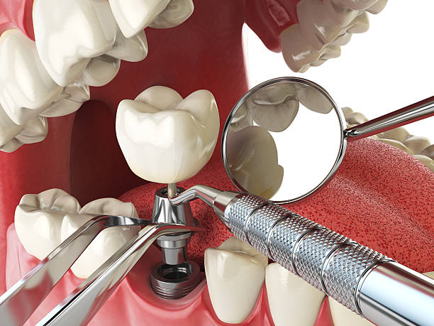 Best Emergency Tooth Extraction in Buckner, KY